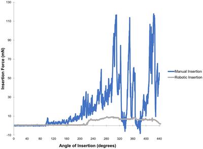 Robotic assistance during cochlear implantation: the rationale for consistent, controlled speed of electrode array insertion